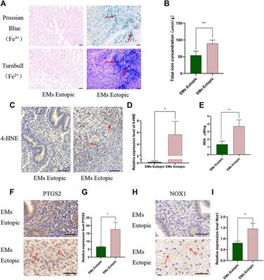 Ferroptosis induced by iron overload promotes fibrosis in ovarian endometriosis and is related to subpopulations of endometrial stromal cells